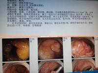 警惕肛周膿腫分泌物流出，不可忽視的健康警報