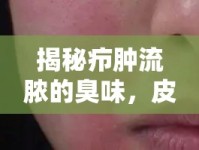 揭秘癤腫流膿的臭味，皮膚感染的警報(bào)信號(hào)