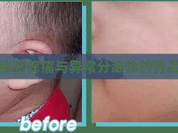 解密眼睛癢痛與異常分泌物的背后真相