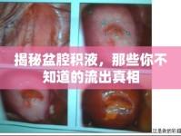 揭秘盆腔積液，那些你不知道的流出真相