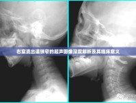 右室流出道狹窄的超聲圖像深度解析及其臨床意義