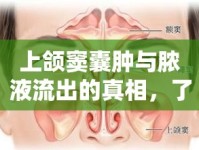 上頜竇囊腫與膿液流出的真相，了解、預(yù)防與治療