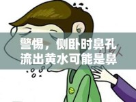 警惕，側(cè)臥時(shí)鼻孔流出黃水可能是鼻竇炎的信號