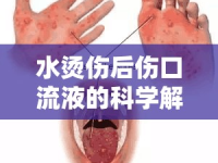 水燙傷后傷口流液的科學解析與家庭護理指南