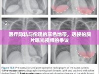 醫(yī)療隱私與倫理的灰色地帶，透視拍胸片曝光視頻的爭議