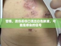 警惕，燙傷后傷口流出白色膿液，可能是感染的信號