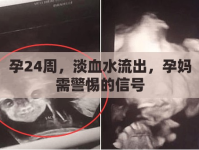 孕24周，淡血水流出，孕媽需警惕的信號
