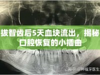 拔智齒后5天血塊流出，揭秘口腔恢復(fù)的小插曲