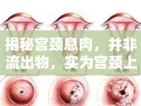 揭秘宮頸息肉，并非流出物，實為宮頸上的小肉芽
