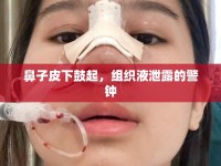 鼻子皮下鼓起，組織液泄露的警鐘