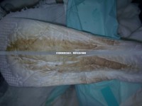 月經(jīng)期間流出血水，原因與應(yīng)對(duì)策略