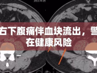 男子右下腹痛伴血塊流出，警惕潛在健康風(fēng)險(xiǎn)
