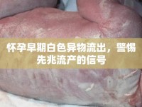 懷孕早期白色異物流出，警惕先兆流產(chǎn)的信號