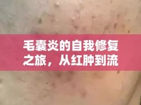 毛囊炎的自我修復(fù)之旅，從紅腫到流水的奇妙轉(zhuǎn)變