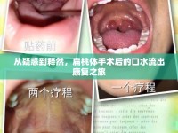 從疑惑到釋然，扁桃體手術(shù)后的口水流出康復(fù)之旅