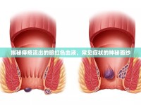 揭秘痔瘡流出的暗紅色血液，常見癥狀的神秘面紗