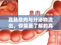 直腸息肉與分泌物流出，你需要了解的真相