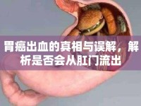 胃癌出血的真相與誤解，解析是否會從肛門流出
