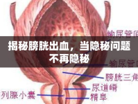 揭秘膀胱出血，當(dāng)隱秘問題不再隱秘