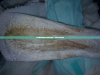 懷孕期間咖啡色分泌物伴血塊，警惕與應對指南