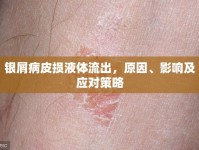 銀屑病皮損液體流出，原因、影響及應對策略
