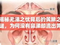 揭秘?zé)o涕之憂背后的黃膿之謎，為何沒有鼻涕卻流出黃色膿液？