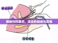 揭秘婦科塞藥，流出的疑惑與真相