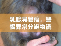 乳腺導(dǎo)管瘤，警惕異常分泌物流出的信號(hào)