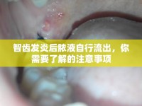智齒發(fā)炎后膿液自行流出，你需要了解的注意事項