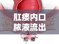 肛瘺內(nèi)口膿液流出的病因、癥狀與治療策略