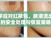科學(xué)應(yīng)對(duì)紅膿包，膿液流出時(shí)的安全處理與恢復(fù)策略