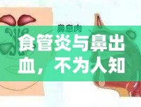 食管炎與鼻出血，不為人知的隱秘聯(lián)系