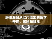 膀胱漏尿從肛門流出的醫(yī)學(xué)奇觀，揭秘與挑戰(zhàn)
