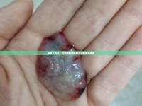 孕囊人流后，科學(xué)理解與情感交織的散落現(xiàn)象