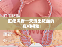 肛瘺患者一天流出膿血的真相揭秘