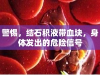 警惕，結(jié)石積液帶血塊，身體發(fā)出的危險(xiǎn)信號(hào)
