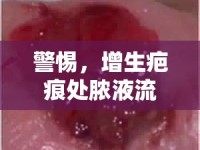 警惕，增生疤痕處膿液流出，潛在健康警報與應對策略