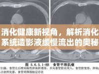 消化健康新視角，解析消化系統(tǒng)造影液緩慢流出的奧秘