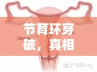 節(jié)育環(huán)穿破，真相、影響及應(yīng)對措施