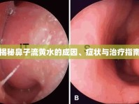揭秘鼻子流黃水的成因、癥狀與治療指南