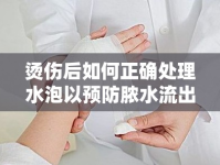 燙傷后如何正確處理水泡以預(yù)防膿水流出