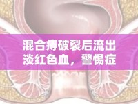 混合痔破裂后流出淡紅色血，警惕癥狀與預(yù)防措施