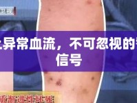 痣上異常血流，不可忽視的警示信號