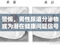 警惕，男性尿道分泌物或為潛在健康問題信號