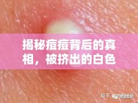 揭秘痘痘背后的真相，被擠出的白色物質(zhì)究竟是什么？
