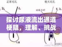 探討尿液流出通道梗阻，理解、挑戰(zhàn)與治療策略