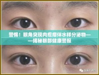 警惕！眼角突現(xiàn)肉疙瘩伴水樣分泌物——揭秘眼部健康警報(bào)