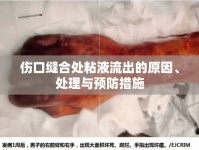 傷口縫合處粘液流出的原因、處理與預(yù)防措施