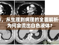 揭秘，從生理到病理的全面解析——為何會流出白色液體？