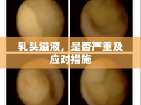 乳頭溢液，是否嚴重及應對措施
